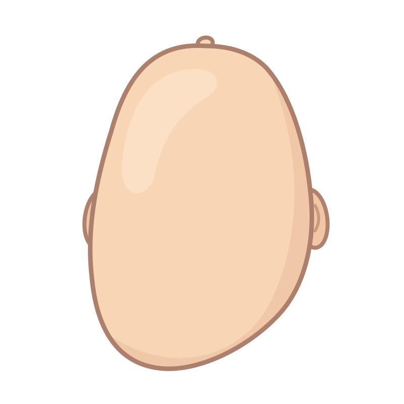 Ilustração de plagiocefalia — achatamento de um lado da parte de trás da cabeça do bebê
